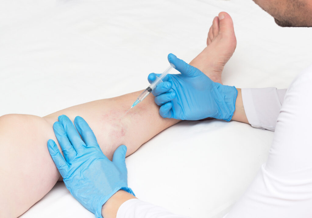 Copy-of-Sclerotherapy-shutterstock_1283406964-1024x716