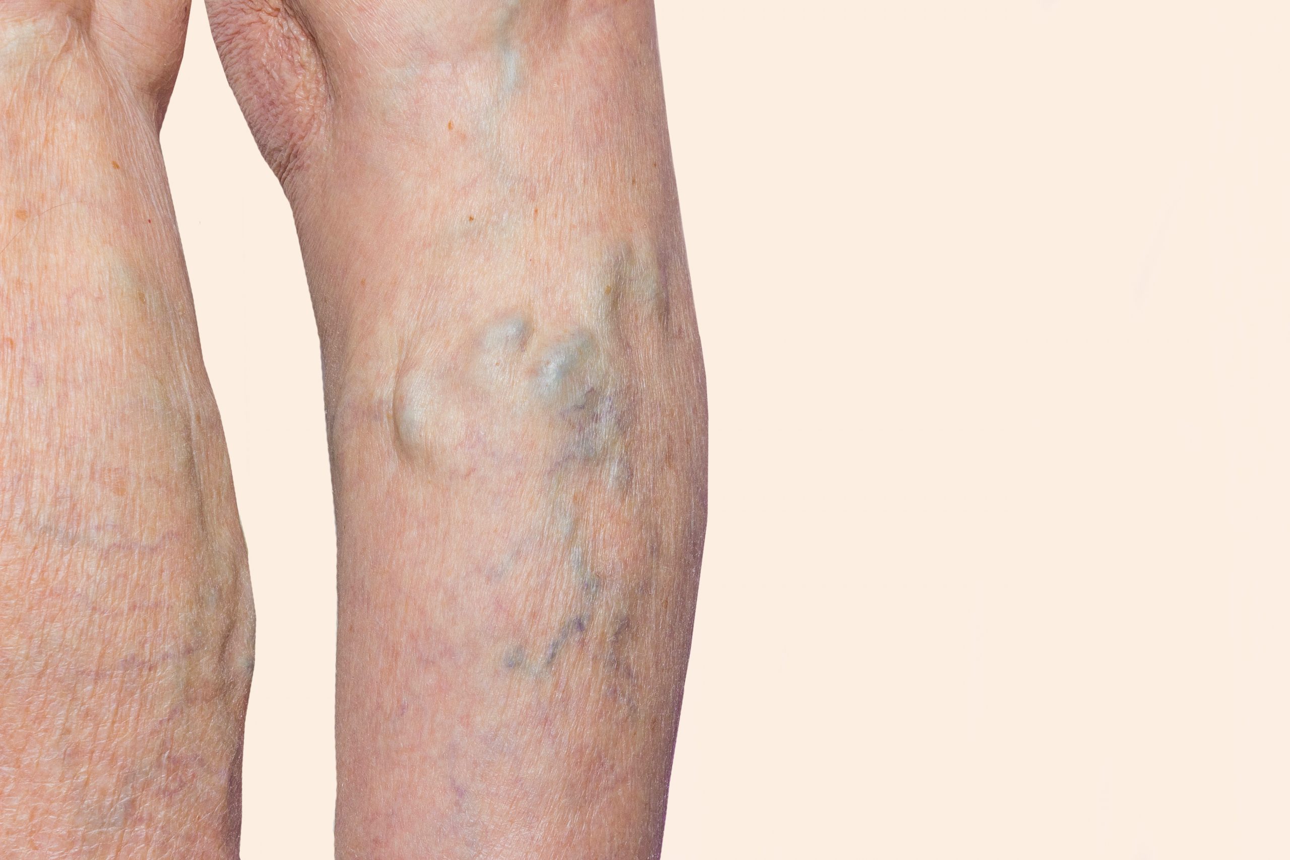 Copy-of-Varicose-Veins-on-Leg-shutterstock_1035063316-scaled (1)