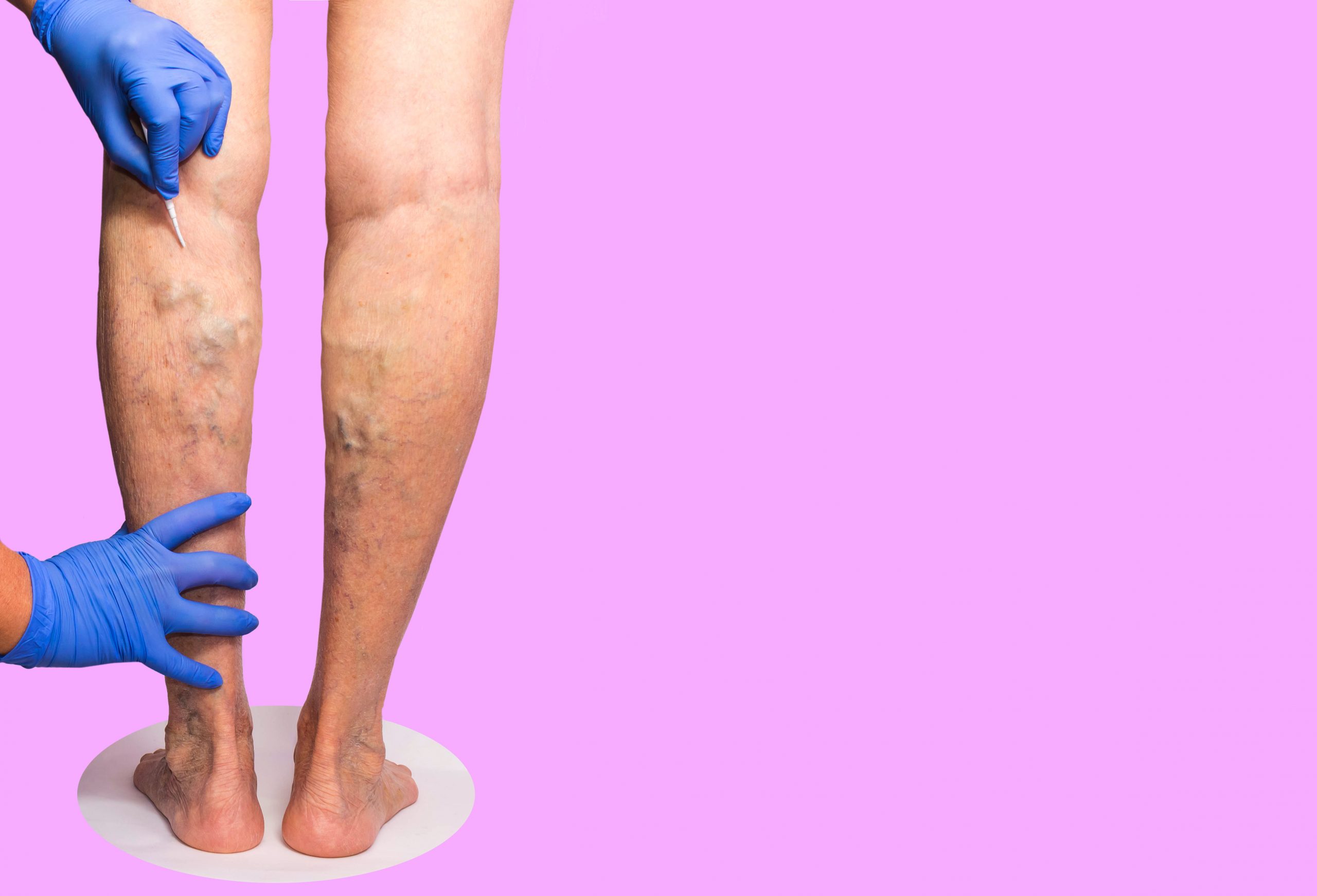 Copy-of-Varicose-Veins-on-legs-with-gloves-hands-shutterstock_1224180379-scaled