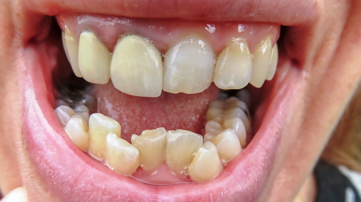 Crooked-bottom-teeth-1296x728-gallery_slide1