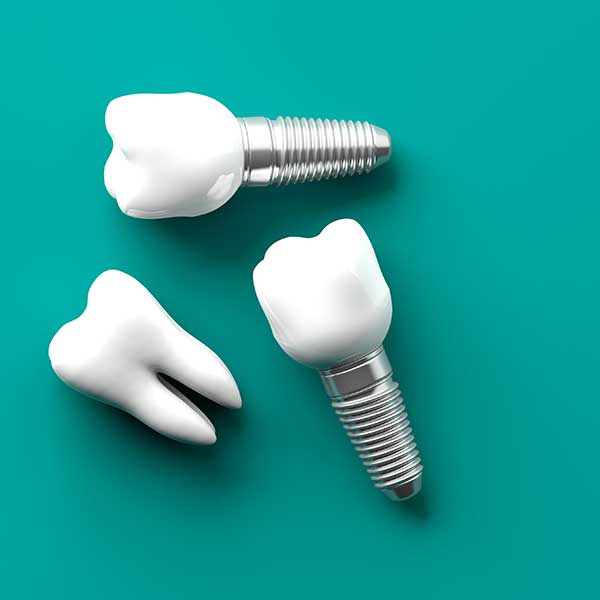 dental-implants-houston-tx