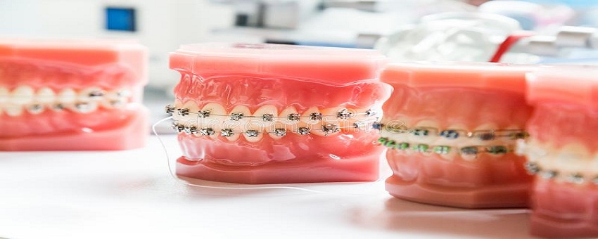 orthodontics-dental-braces-teeth-model-to-align-teeth-orthodontics-dental-braces-teeth-model-to-align-strengthen-teeth-104124787