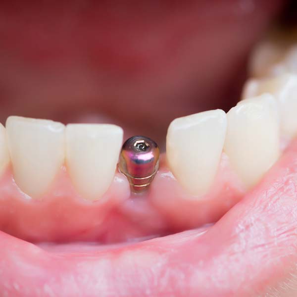 single-tooth-implant-near-me